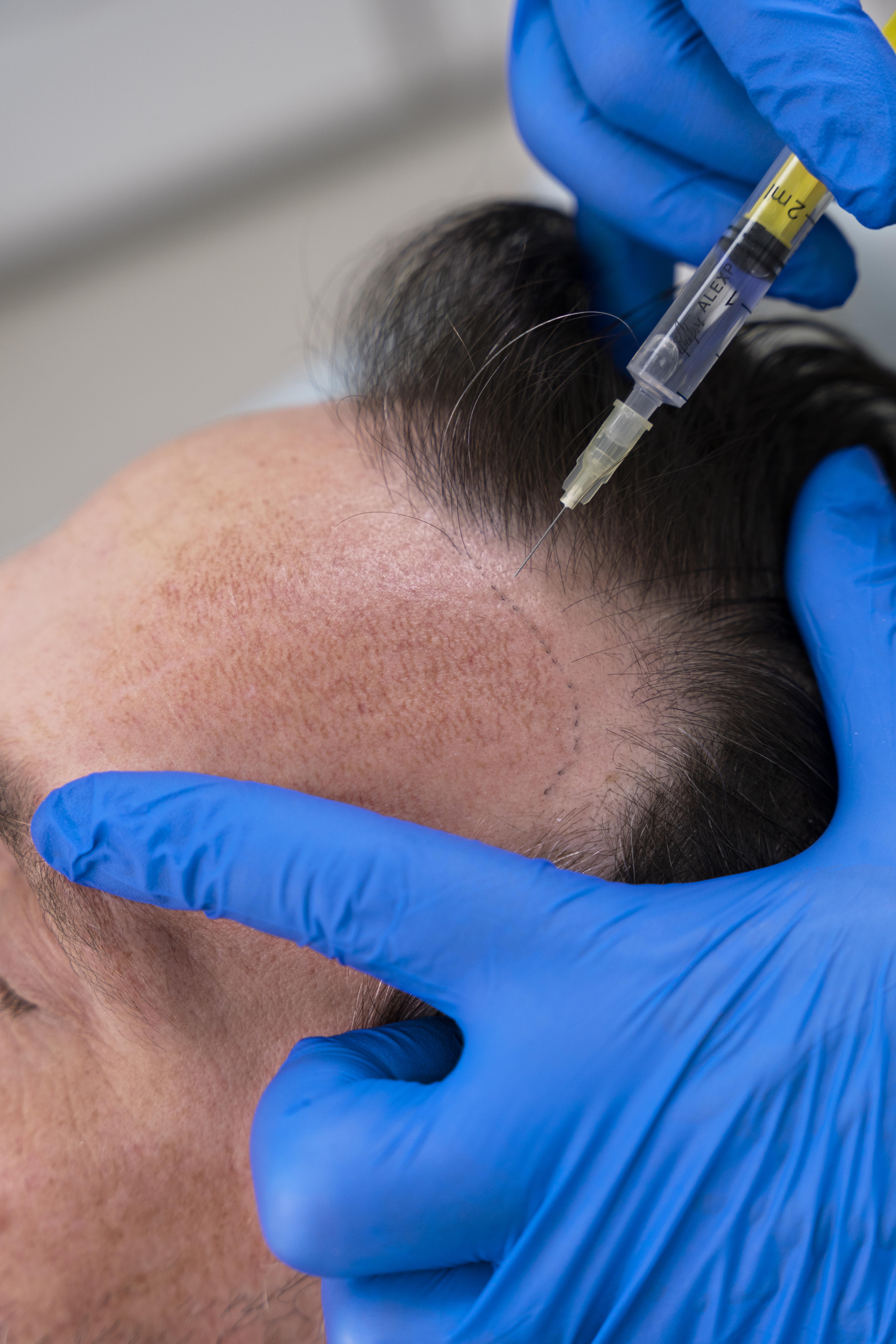 Scalp Micropigmentation